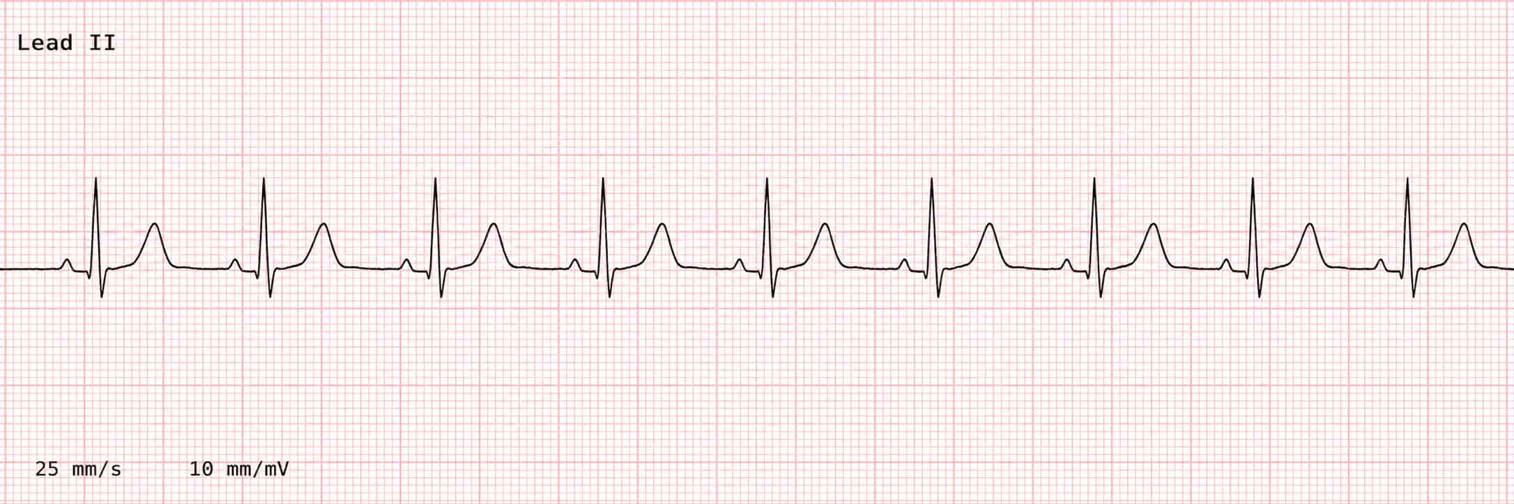 ECG_CaseStudy