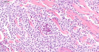 mast cell tumour in a ferret