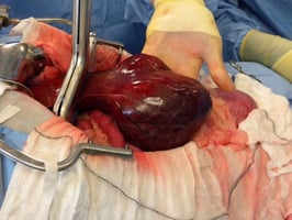 Canine hepatobilary tumour surgery