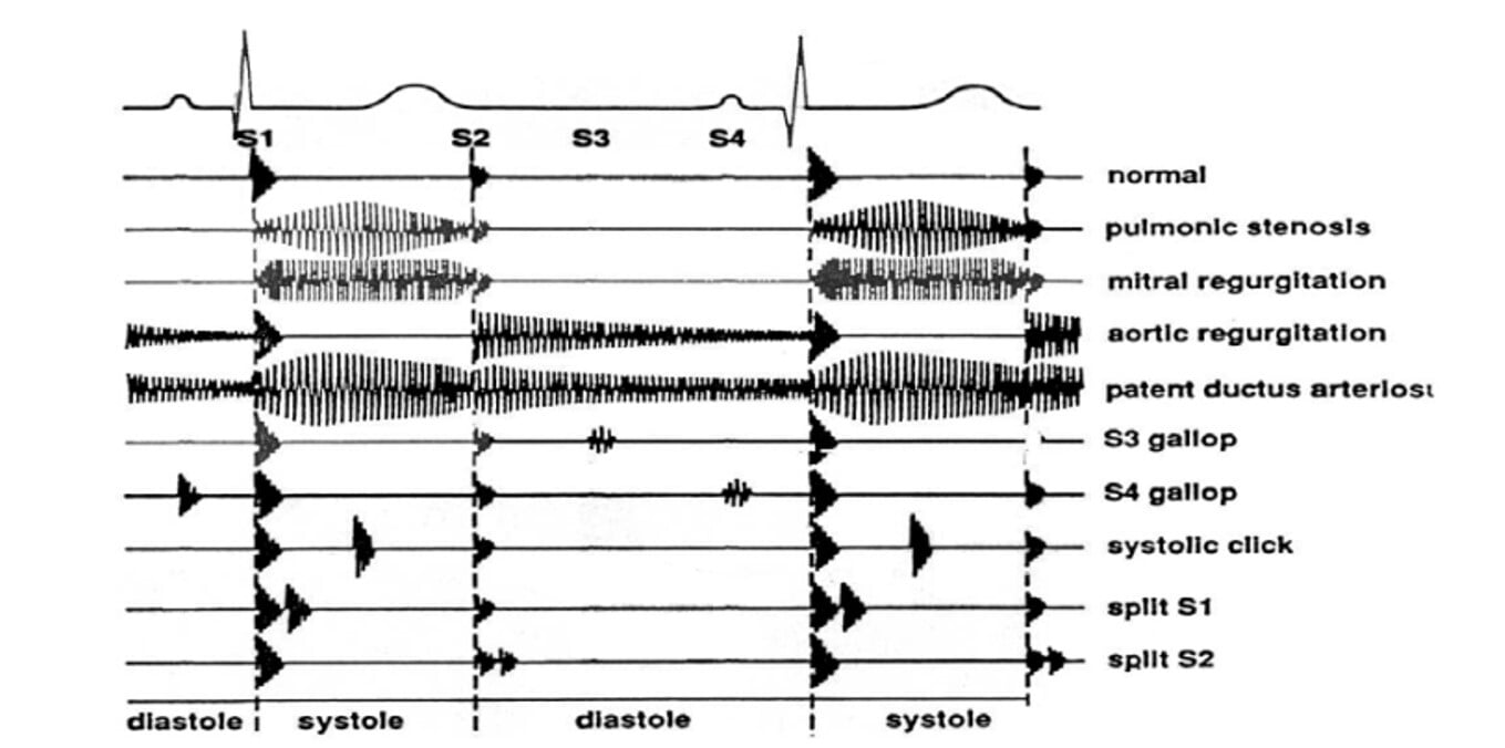 An ECG of heat murmurs