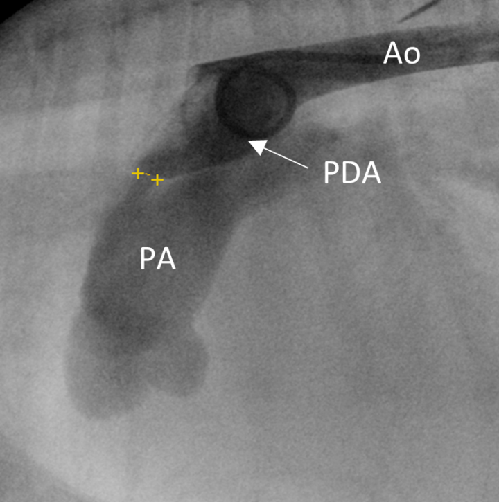 Patent ductus arteriosus in dogs: diagnosis and interventional occlusion