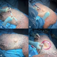 Correct surgical margins for subcutaneous masses in dogs can be difficult to achieve