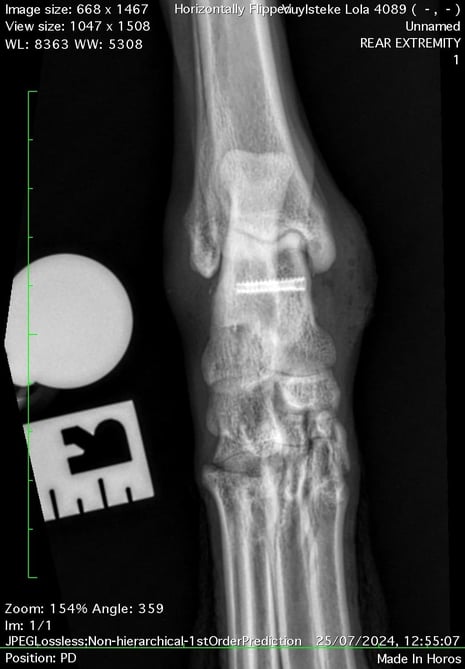 Intraoperative x-ray of screw placement 