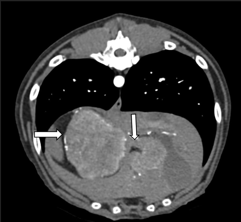A CT scan showing metastatic nodules in the liver