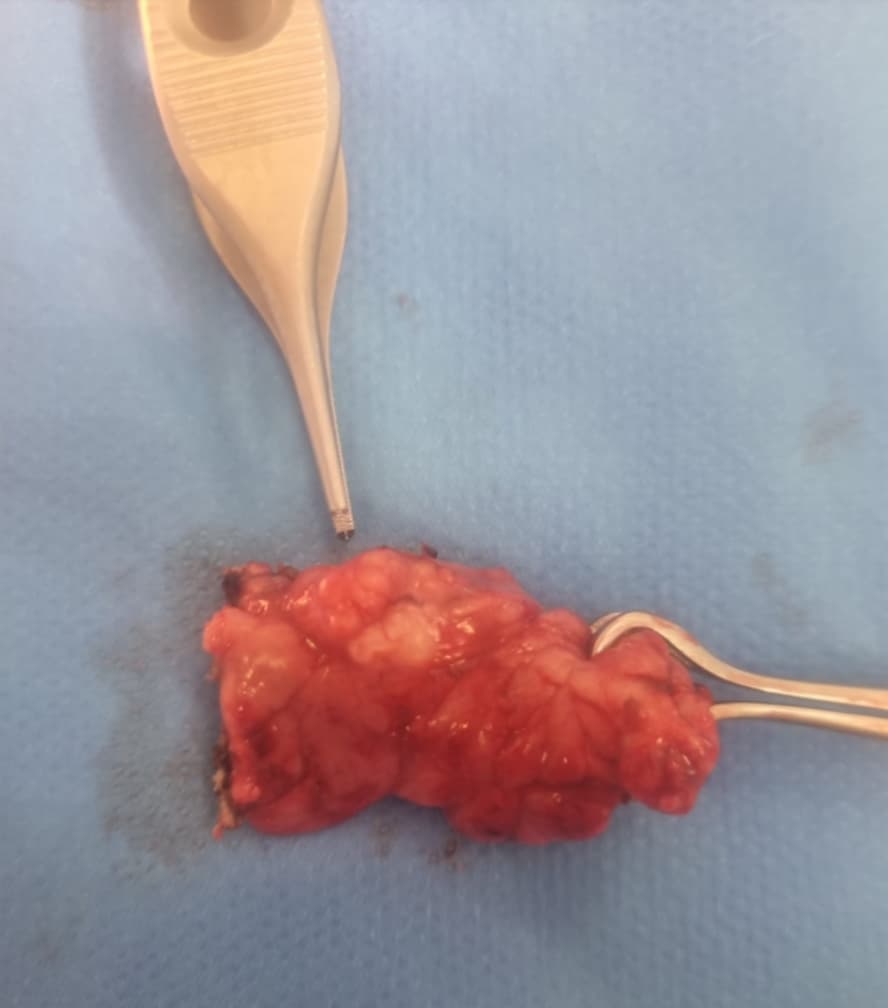 Partially excised canine pancreas