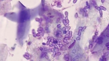 Malessezia overgrowth under the microscope